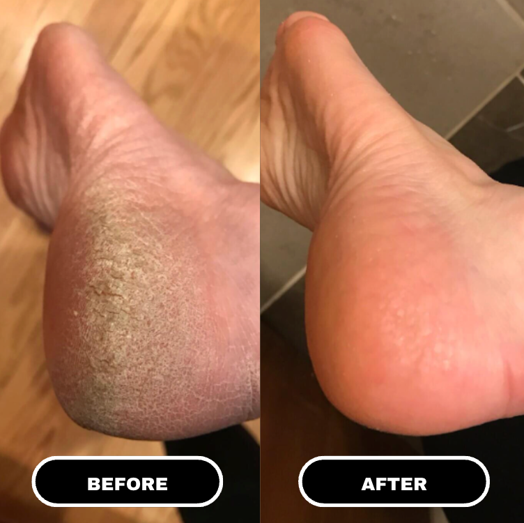 Antes e depois calcanhar